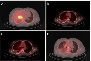 A collage of x-ray images of a lung

Description automatically generated