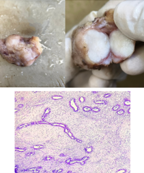 Figure 1. (A) Gross picture of excised 4x2x2 cm encapsulated nodular breast lump from right breast. (B) cut surface of right breast lump showing well-circumscribed homogeneous white fleshy area. (C) H&E-stained section at 200x showing fibroadenoma (pericanalicular pattern) with no stromal atypia.